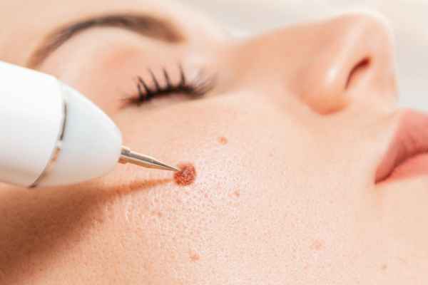 CryoPen: 5 Skin Concerns It May Be Used to Treat 3 What actually happens during a CryoPen treatment Calne?