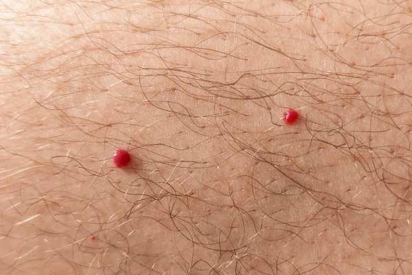 CryoPen: 5 Skin Concerns It May Be Used to Treat 2 cherry angioma removal Calne