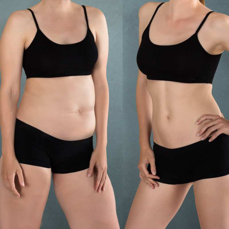Does Fat Freezing at Home Work? DIY Devices vs Professional Cryolipolysis 2 before and after Cryolipolysis Calne