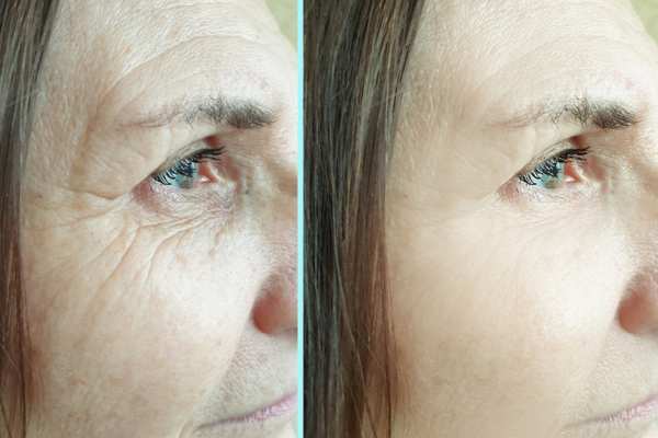 Why Do People Choose HIFU for a Non-Surgical Facelift? 4 How long can HIFU results last Calne?