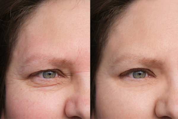 HIFU vs Botulinum Toxin: Understanding the Differences 4 How long do HIFU results last Calne?