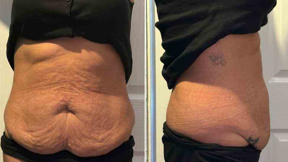 Lost the Weight but Not the Loose Skin? What You Should Know 1 Is It Definitely Loose Skin Calne?